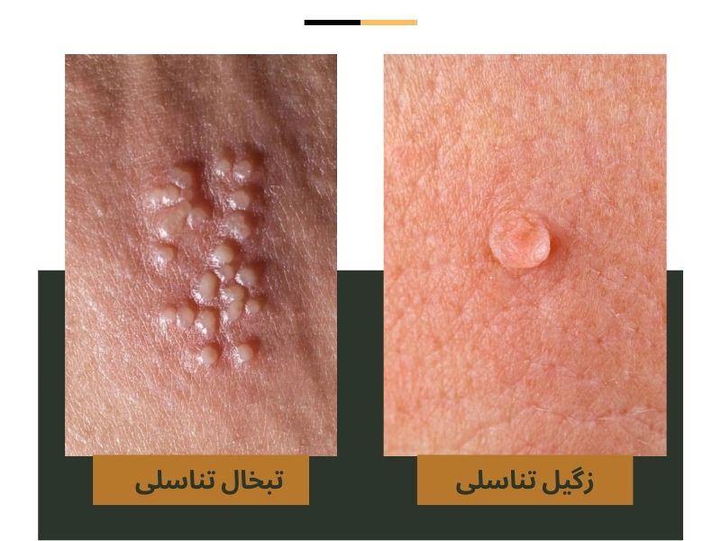 مقایسه زگیل تناسلی و تبخال تناسلی