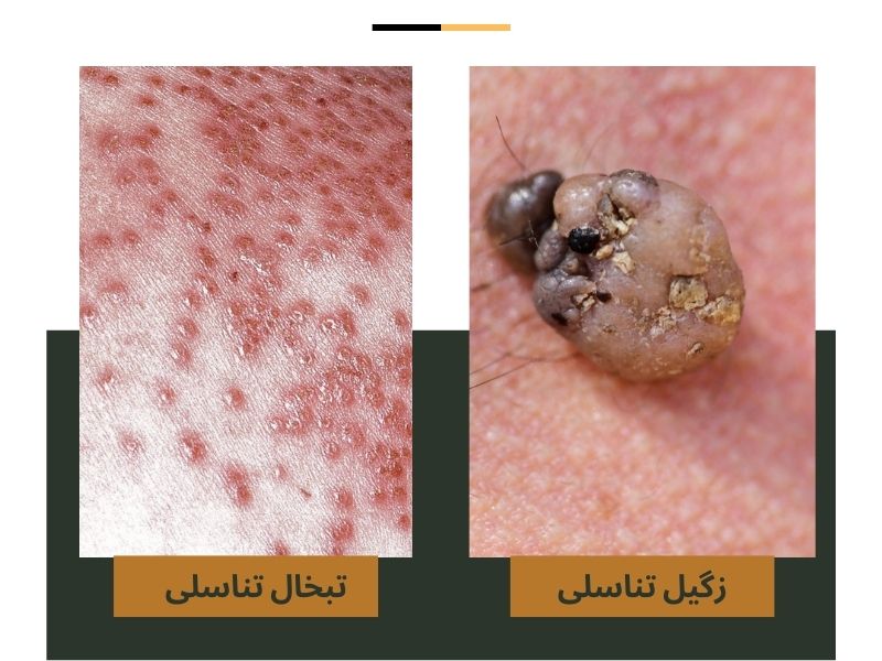  عکس‌ تفاوت زگیل تناسلی و تبخال تناسلی 