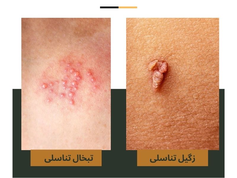با تفاوت زگیل تناسلی و تبخال تناسلی آشنا شوید