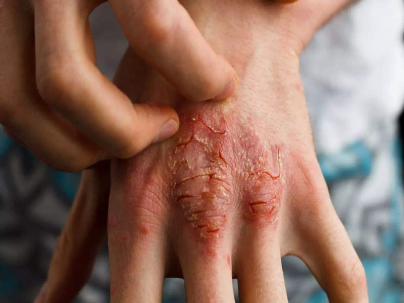 انواع بثورات HIV 