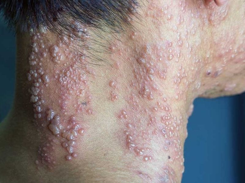 ابتلا به نشانه‌های ویروس‌ هرپس در بیمار HIV مثبت