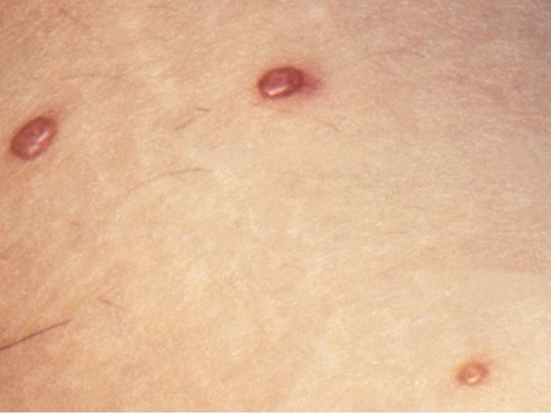 مولوسکوم کونتاژیوزوم؛ یکی از بثورات پوستی HIV