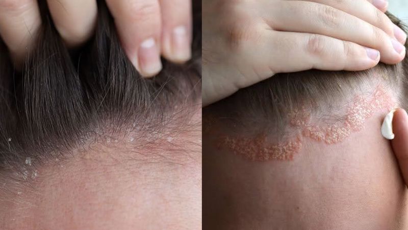 درماتیت سبوره‌ای (Seborrheic Dermatitis)