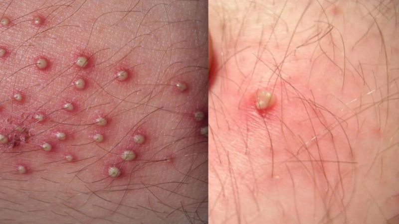 فولیکولیت ائوزینوفیلی (Eosinophilic Folliculitis)