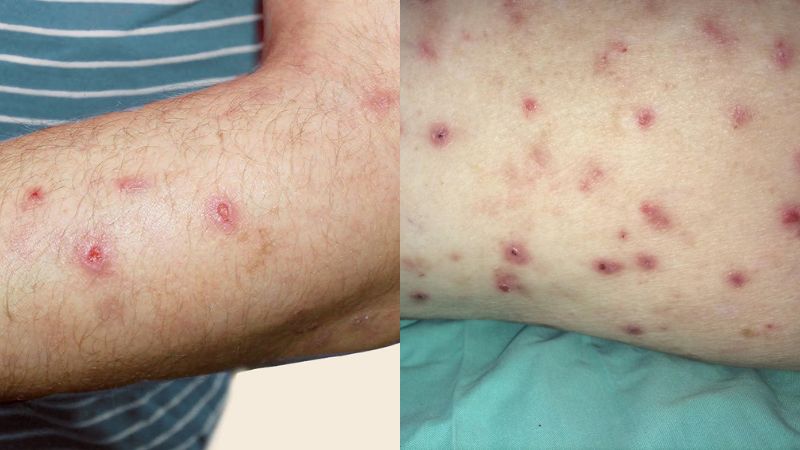 پروریگو نودولاریس (Prurigo Nodularis)
