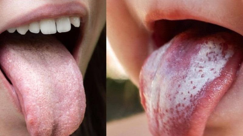 برفک دهانی (Oral Thrush)