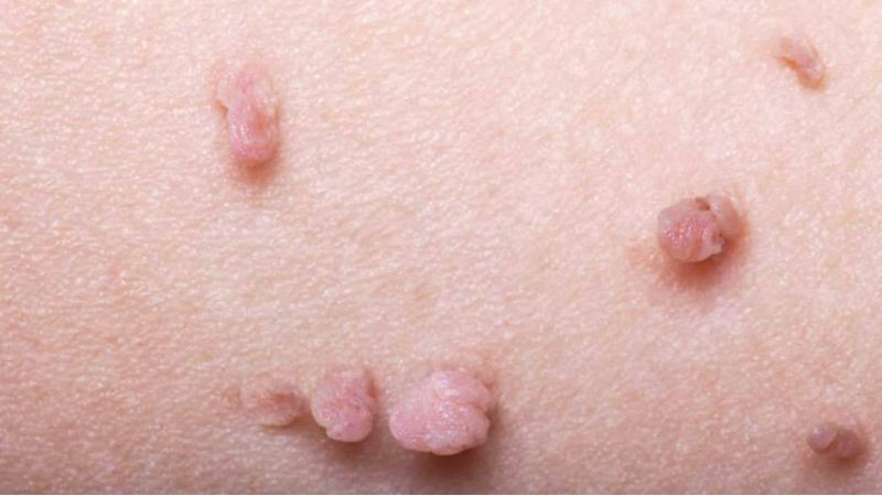 زگیل تناسلی (Genital Warts)