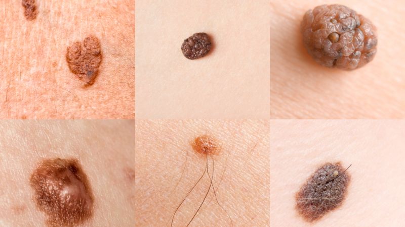 سرطان پوست (Skin Cancer)