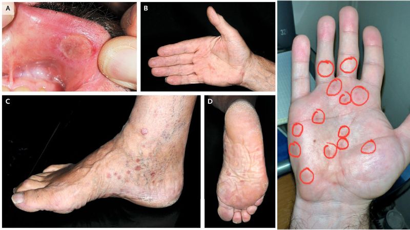 جوش یا ضایعه ناشی از سوزاک (Syphilis Rash)