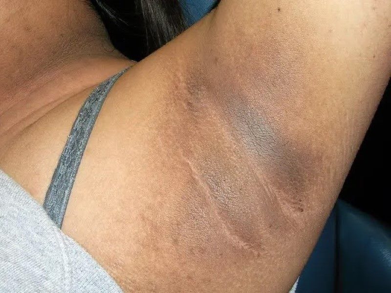 آکانتوز نیگریکنس (Acanthosis Nigricans)