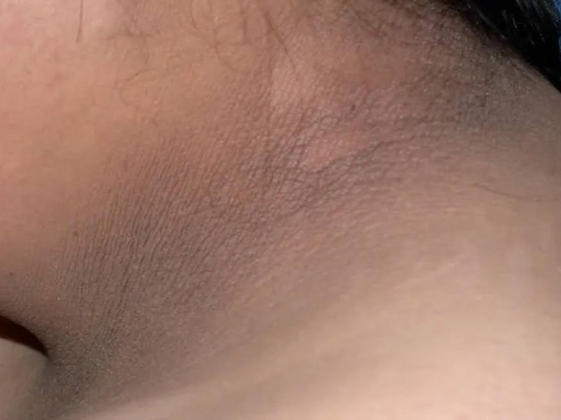 آکانتوز نیگریکنس (Acanthosis Nigricans)
