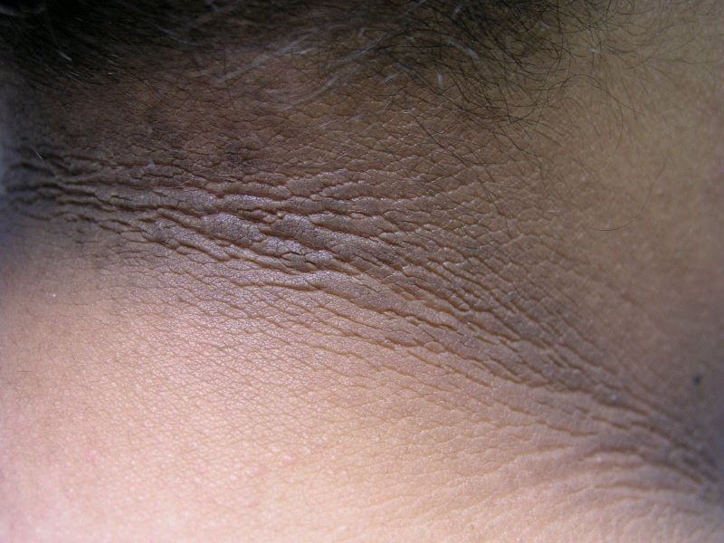 آکانتوز نیگریکنس (Acanthosis Nigricans)