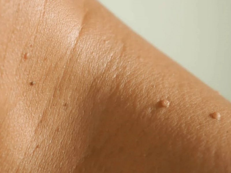 تگ‌های پوستی (Acrochordons - Skin Tags)