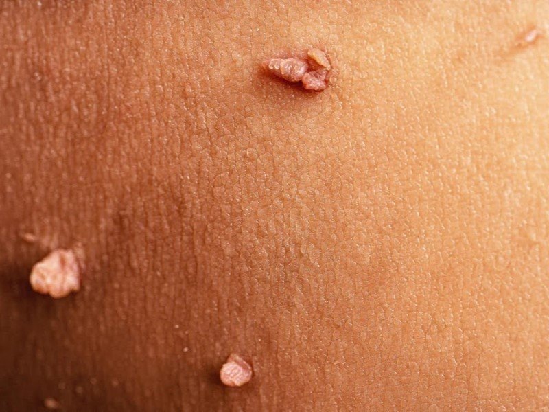 تگ‌های پوستی (Acrochordons - Skin Tags)