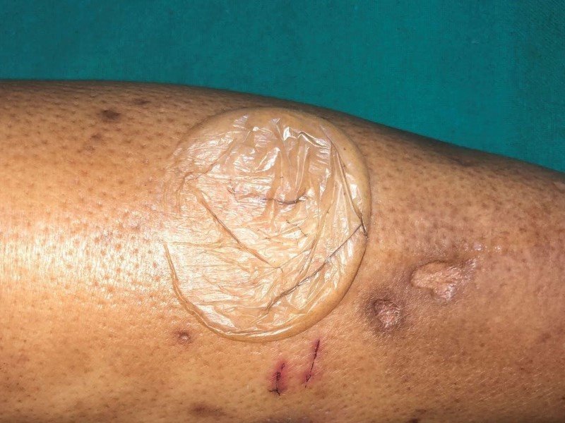 تاول‌های دیابتی (Bullosis Diabeticorum / Diabetic Blisters)