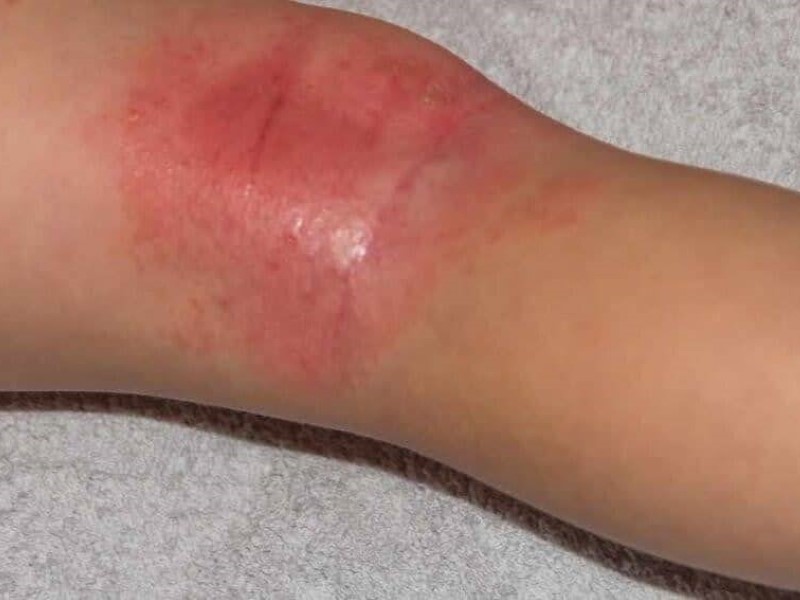 درماتیت تماسی آلرژیک