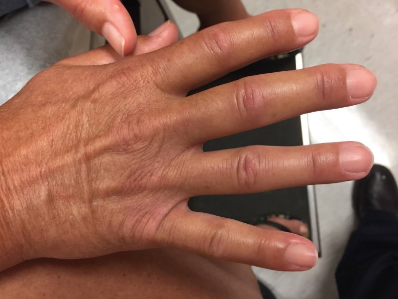 اسکلروز دیجیتال (Digital Sclerosis / Diabetic Cheiroarthropathy)