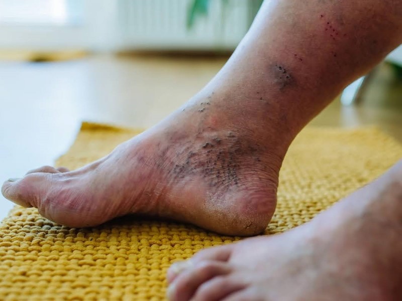 سندرم پای دیابتی (Diabetic Foot Syndrome)
