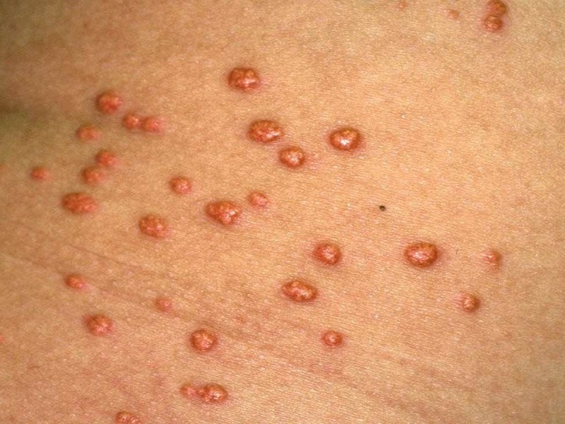 گزانتومای اراپتیو (Eruptive Xanthomatosis)