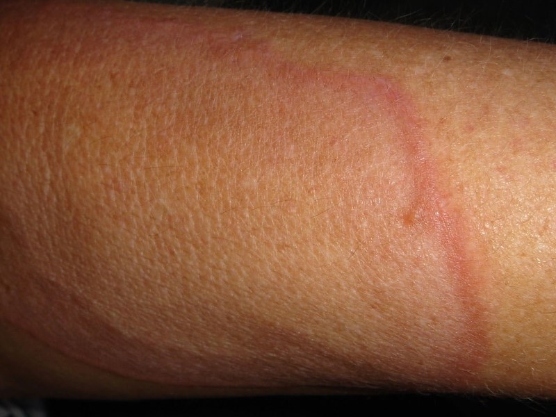 گرانولوم آنولار (Granuloma Annulare)