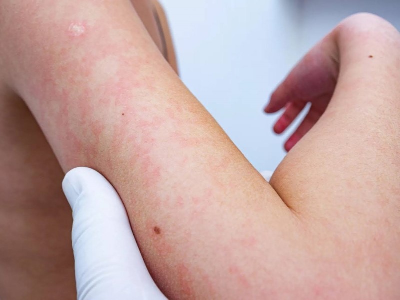 کهیر (Hives)
