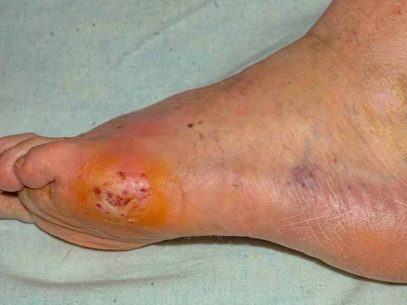 عفونت‌ها (Infections)