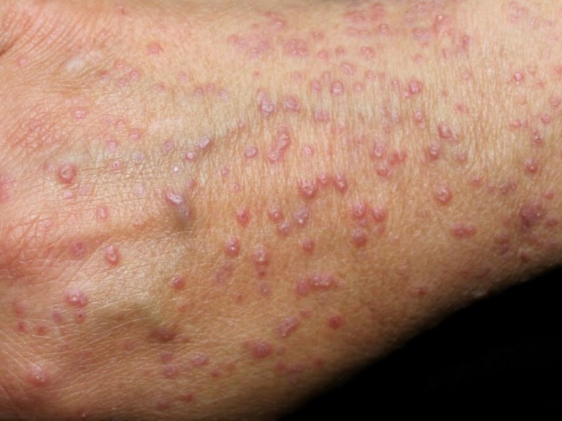 لیکن پلان (Lichen Planus)