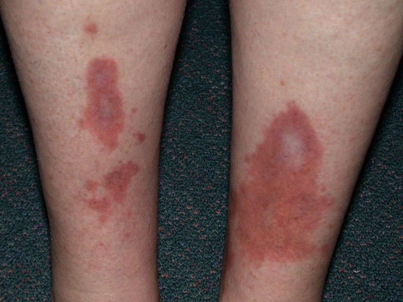 نکروبیوزیس لیپوئیدیکا (Necrobiosis Lipoidica)