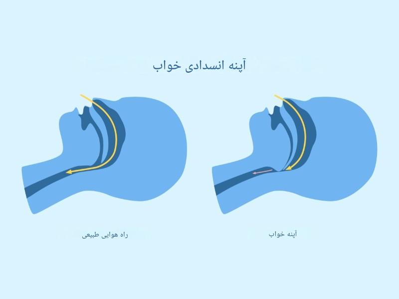 چه چیزی باعث آپنه انسدادی خواب می‌شود؟