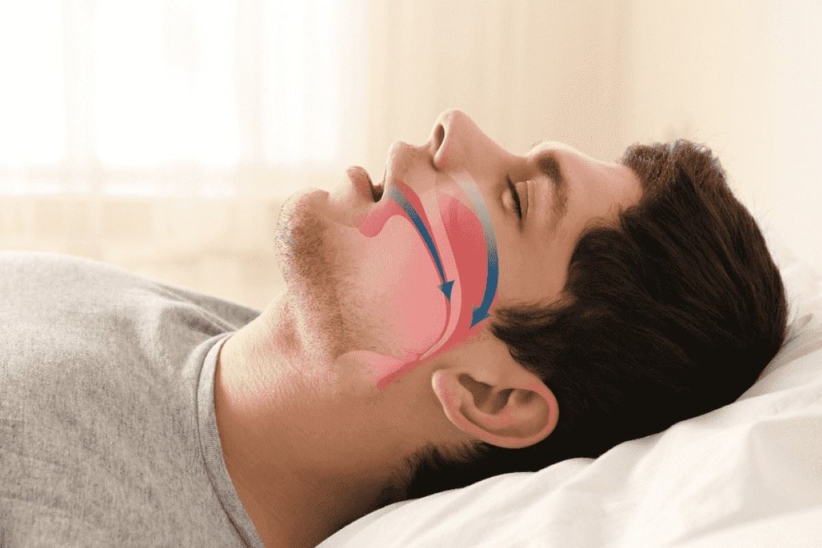 آپنه انسدادی خواب چیست؟ راهنمای علائم، تشخیص و درمان OSA