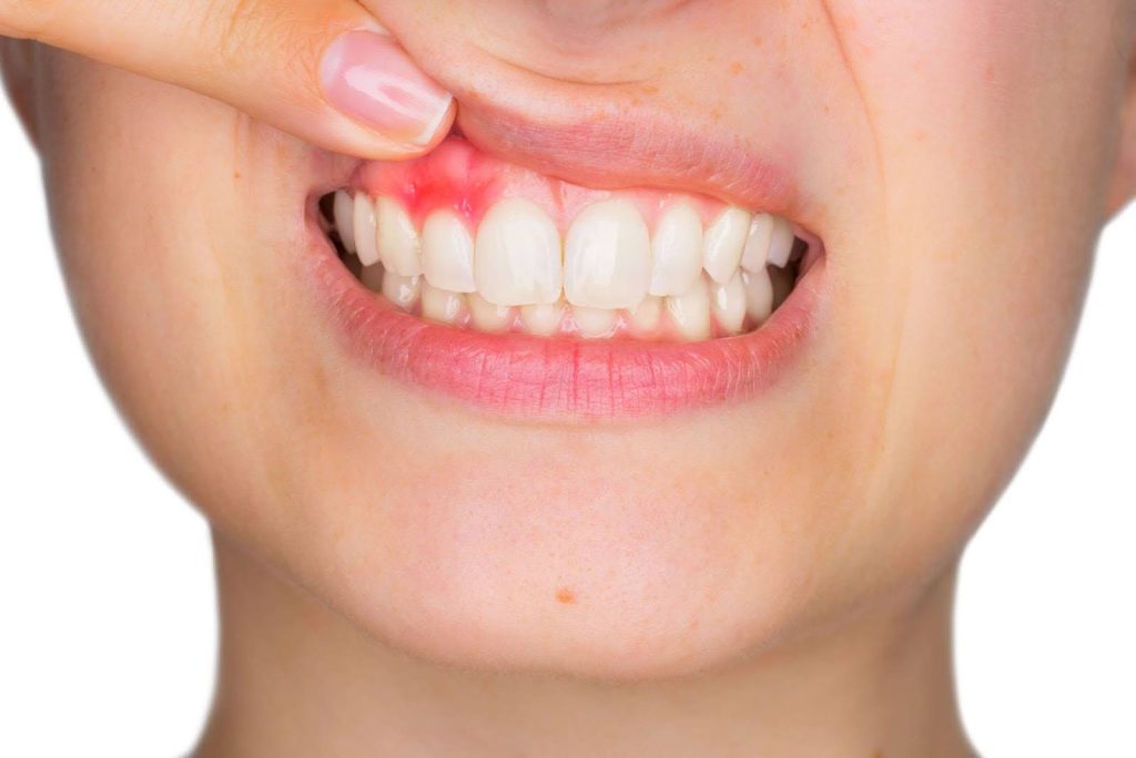 علائم دیابت در دهان و دندان چیست؟