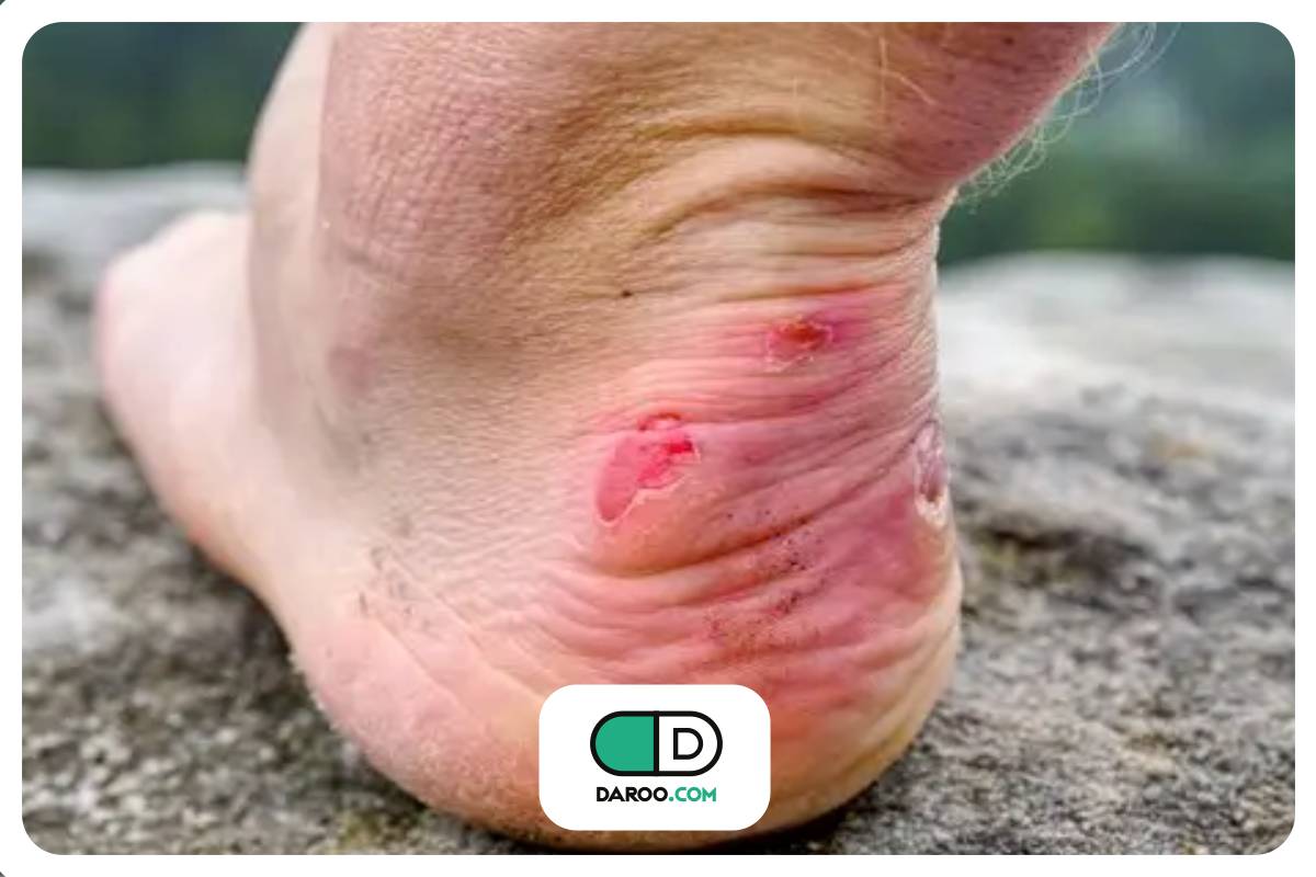 علائم پوستی دیابت