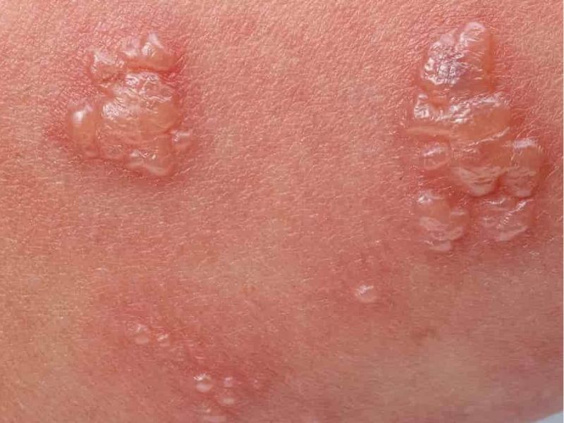 تفاوت علائم تبخال تناسلی و زگیل تناسلی چیست؟
