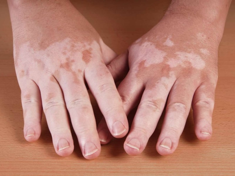 ویتیلیگو (Vitiligo)