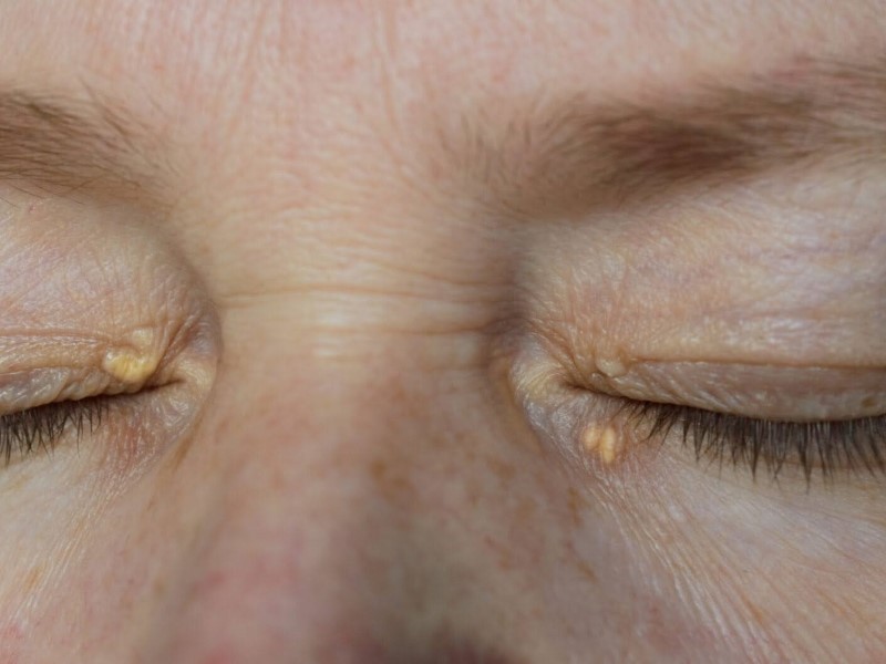 زانتلاسما (Xanthelasma)