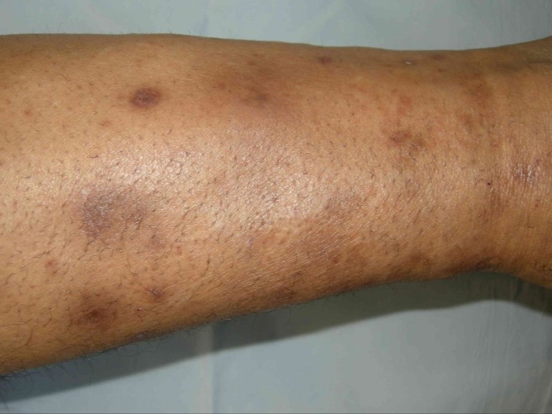لکه‌های ساق پا (Shin Spots)، درموپاتی دیابتی (diabetic dermopathy)، سندرم پای لکه‌دار (spotted leg syndrome)