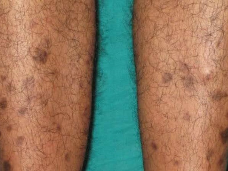 لکه‌های ساق پا (Shin Spots)، درموپاتی دیابتی (diabetic dermopathy)، سندرم پای لکه‌دار (spotted leg syndrome)