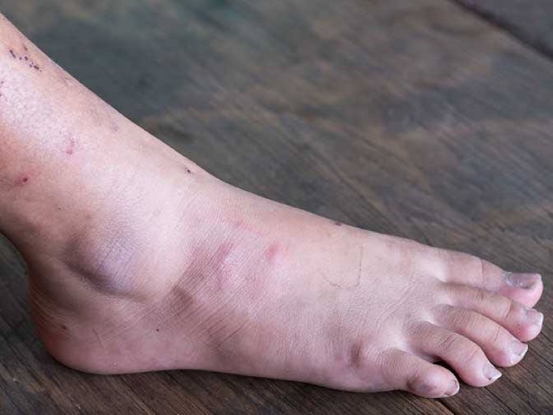 زخم‌های دیابتی (diabetic ulcers)