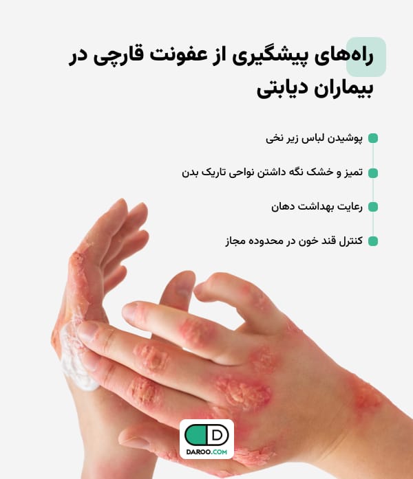 راههای پیشگیری از عفونت قارچی در بیماران دیابتی