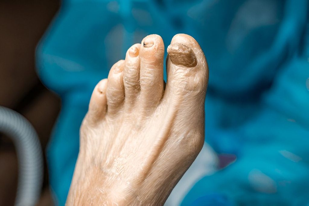 عفونت های قارچی و دیابت