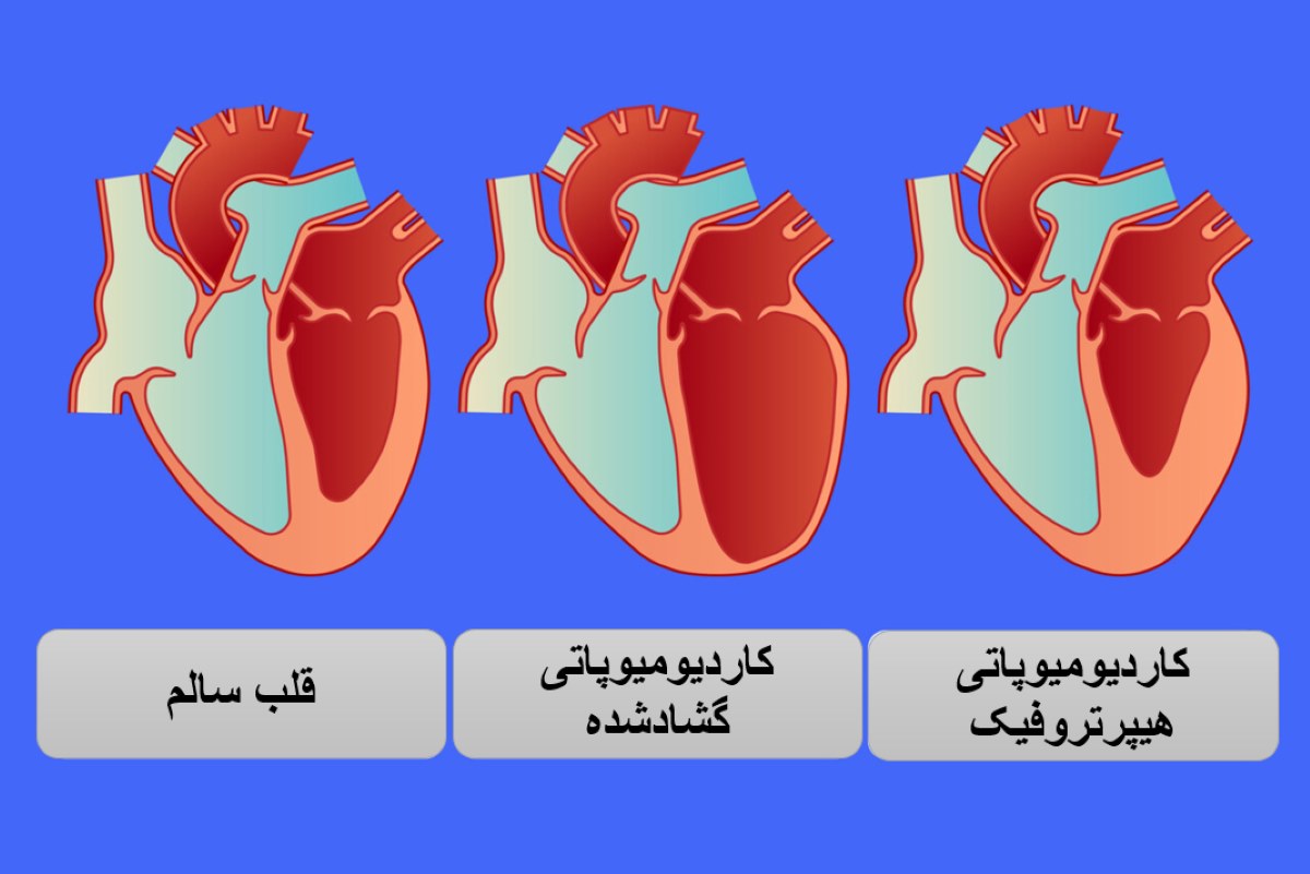 کاردیومیوپاتی چیست؟ بررسی روش‌های درمان ضعف عضله قلب