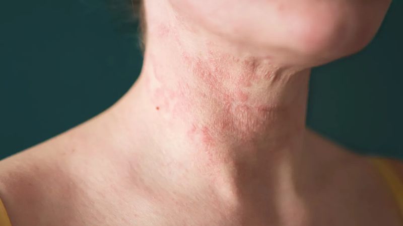 کم کاری تیروئید و خشکی پوست