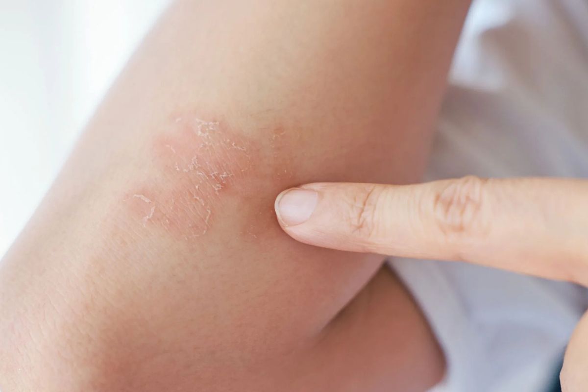 چرا کم‌ کاری تیروئید باعث خشکی پوست می‌شود؟ کم کاری تیروئید و پوست خشک