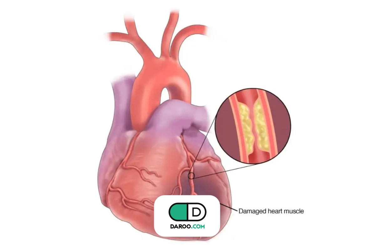 بیماری عروق کرونر چیست؟ علائم، دلایل و راه‌های درمان