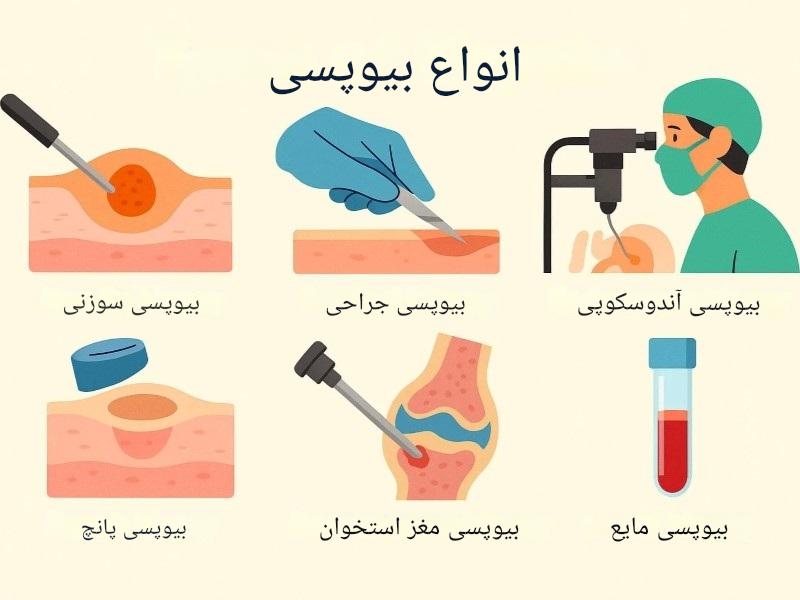 انواع بیوپسی