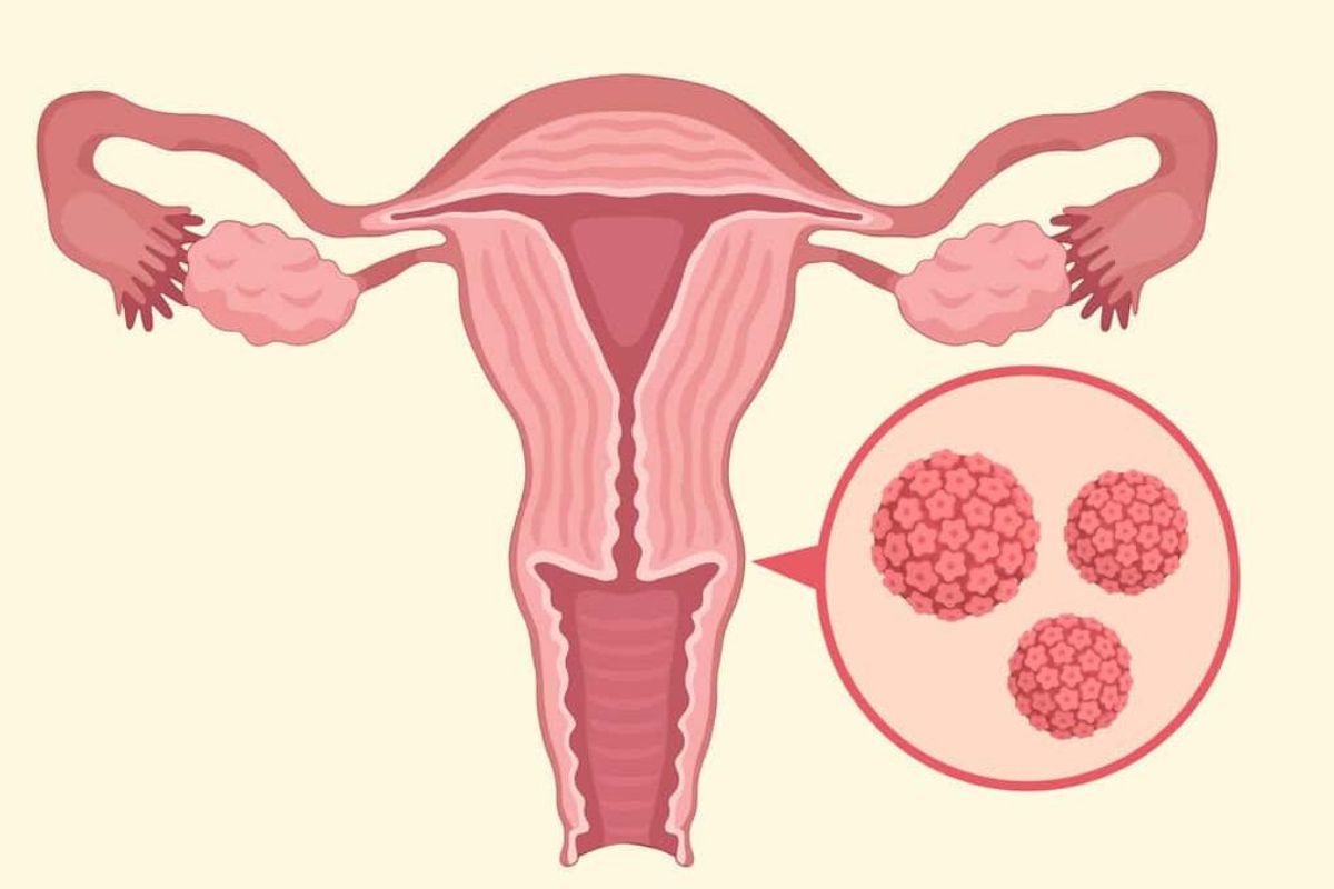 انواع زگیل تناسلی یا انواع ویروس اچ پی وی (HPV) کدامند؟