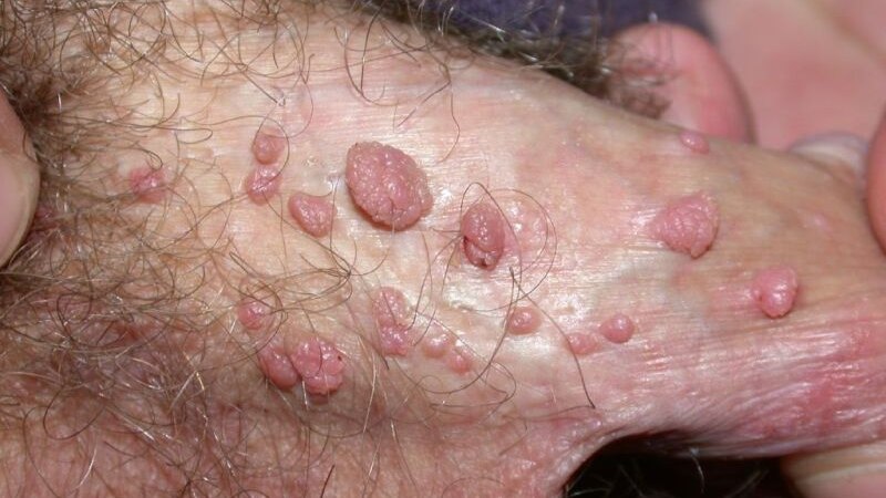زگیل تناسلی (HPV) در مردان 