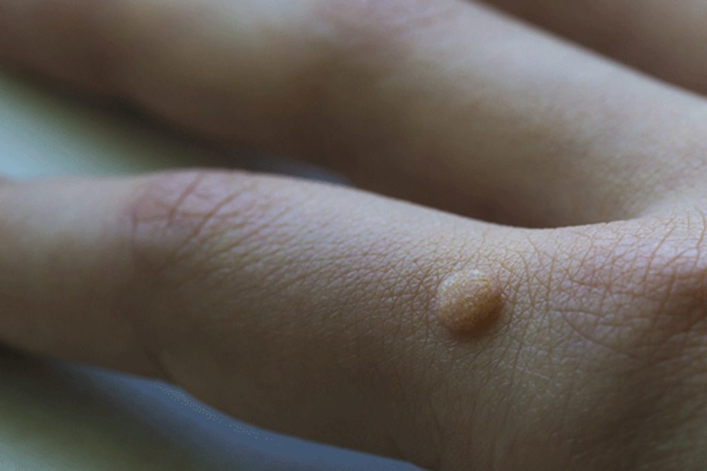 علت زگیل دست