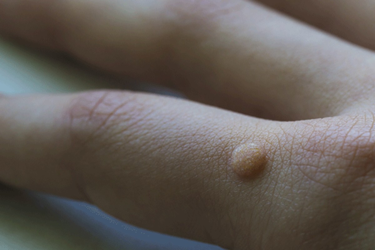 علت زگیل دست