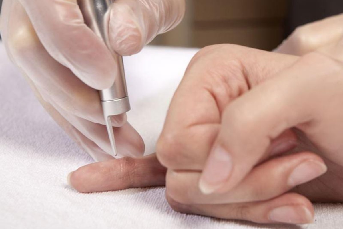 مراقبت های بعد از درمان زگیل تناسلی با لیزر